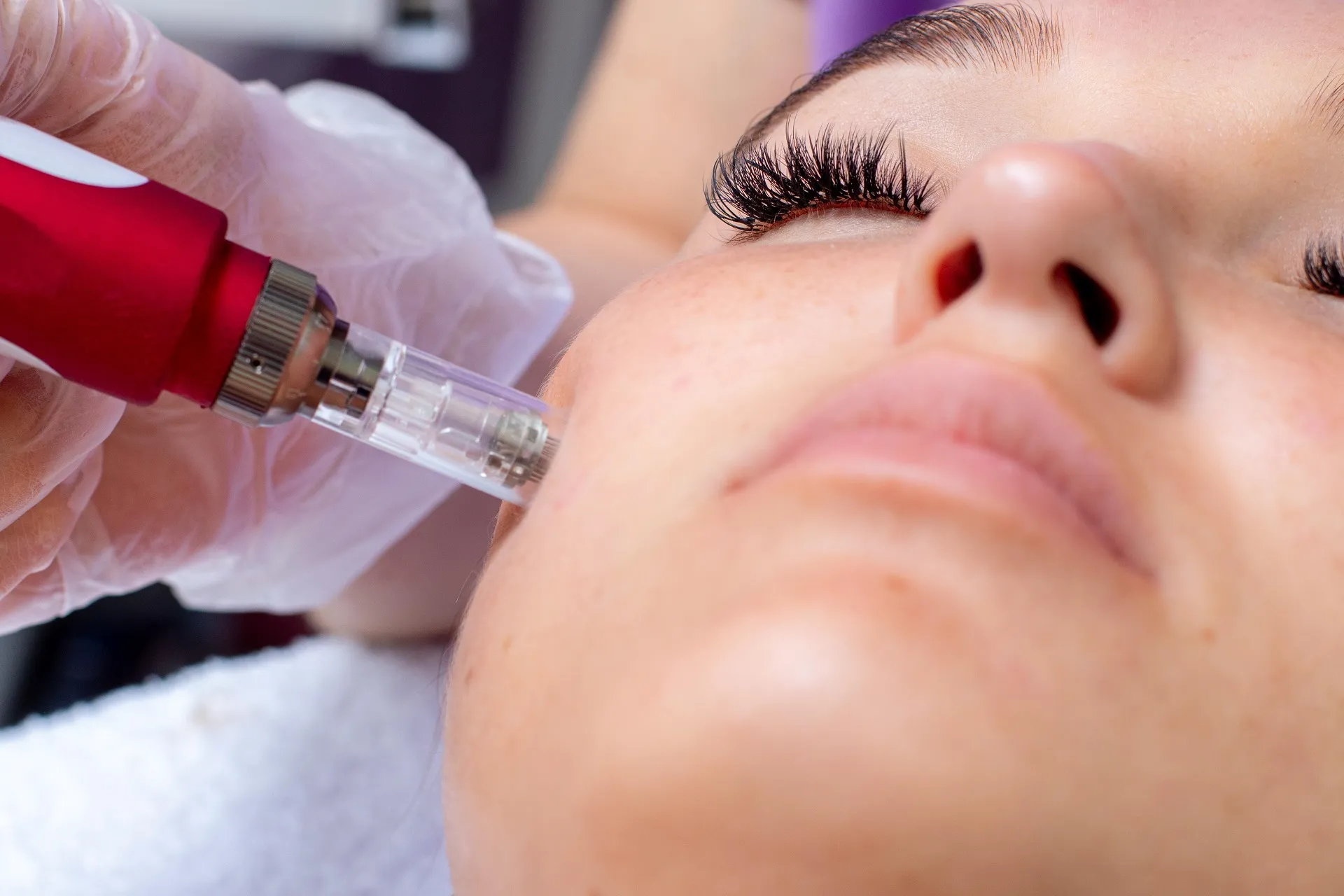 Microneedling in Pompano Beach, FL by Essential Aesthetics