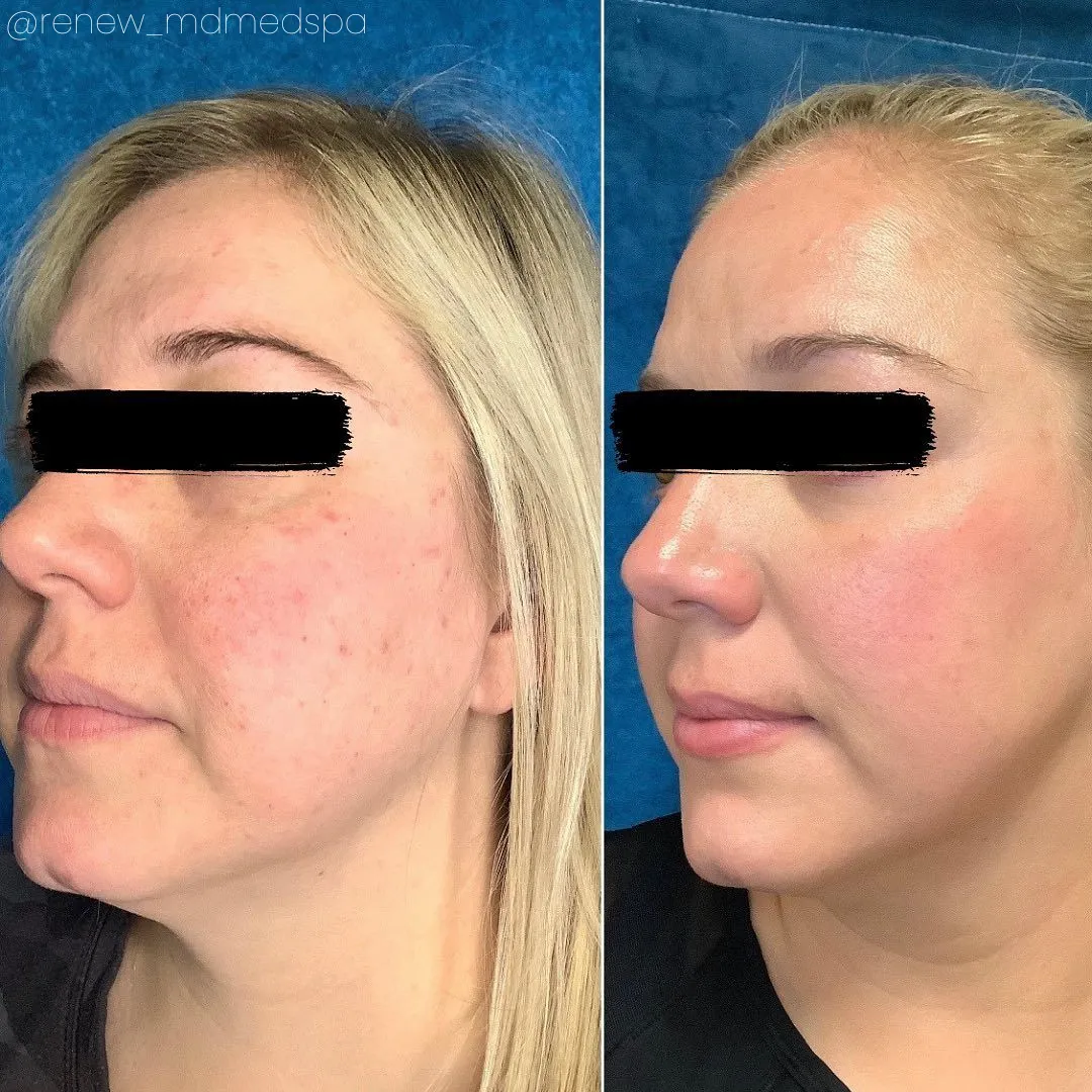 Neo Elite® - NeoSkin® - Skin Rejuvenation