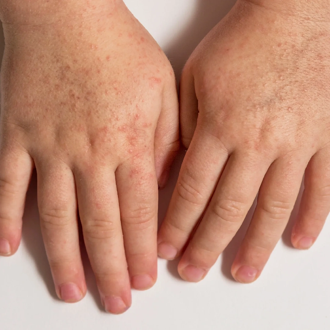 Essential Aesthetics & Health Aerolase Laser Treatments