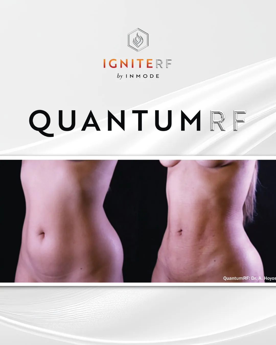 Quantum RF by InMode®| Fort Lauderdale, FL | Essential Aesthetics & Health