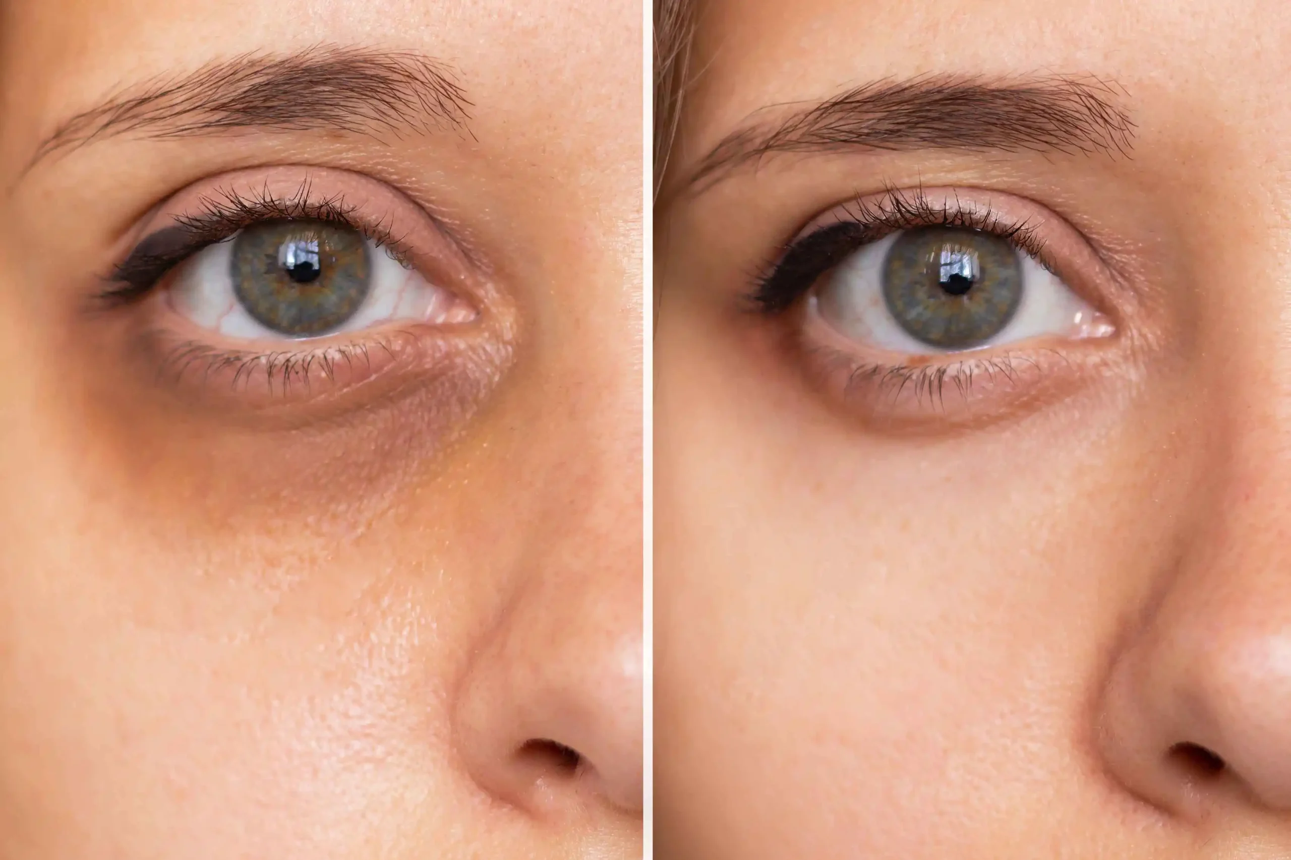 Non-Surgical Under-Eye Rejuvenation Results at Essential Aesthetics & Health in Florida